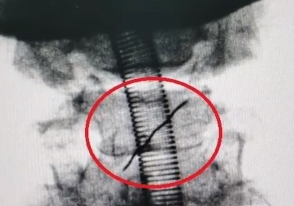 食後喉に痛みを訴える男、CT検査で衝撃の事実を知る│100000dobu | 衝撃動画・面白動画